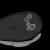 SPORK, NICO - 22.03.1976 - 02.08.2022 - CT obere Extremität - 18:02:23